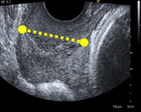 medida longitud cervical